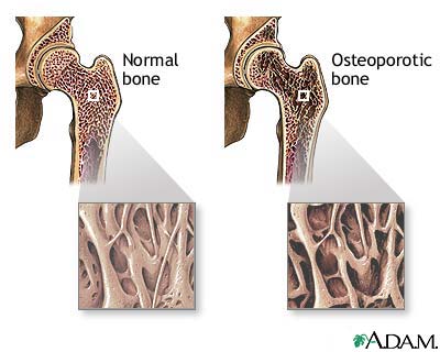Osteoporoza neden olan hastalıklar ve ilaçlar