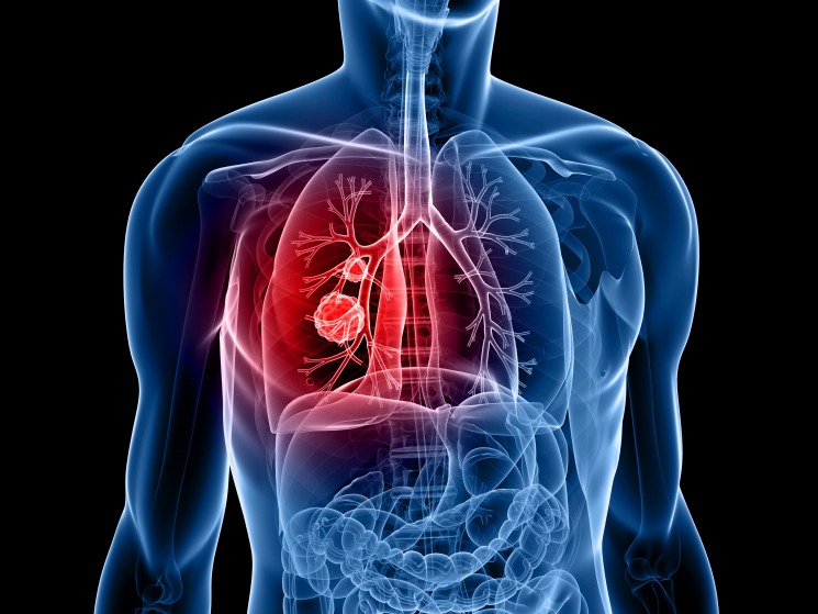 Akciğer Kanseri Riskiniz Ne Kadar?