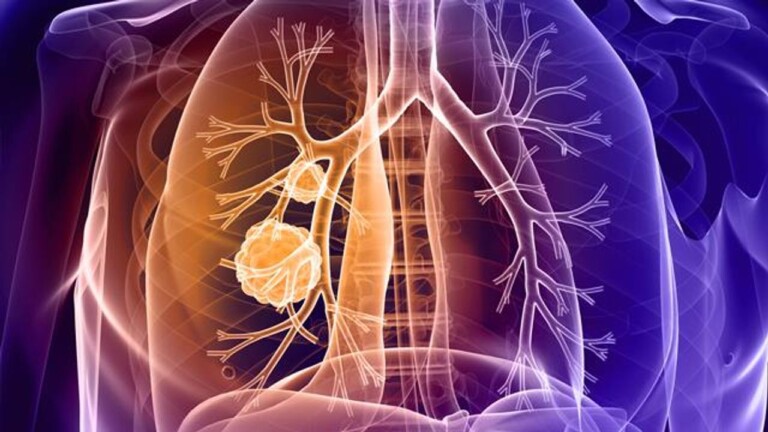 Akciğer Kanseri Tedavisinde Yeni Gelişmeler