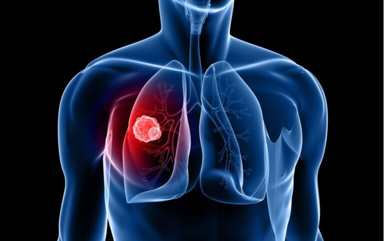 Küçük hücreli akciğer kanserinde Tarlatamab kullanımı FDA onayı aldı