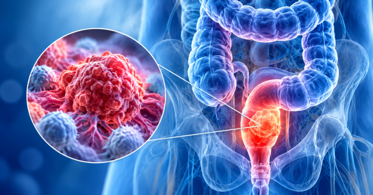 Rektum Kanserinde Yeni Dönem: Dostarlimab ile Ameliyatsız Tedavi Mümkün mü?